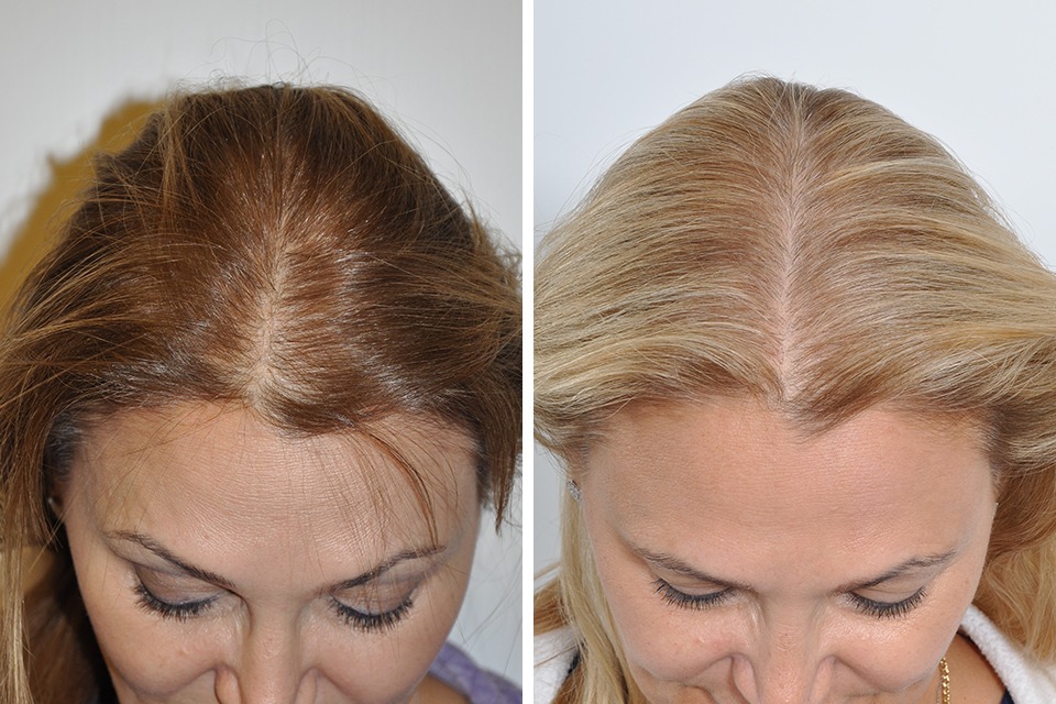 Why Choose Westminster Medical Group for Hair Transplant London