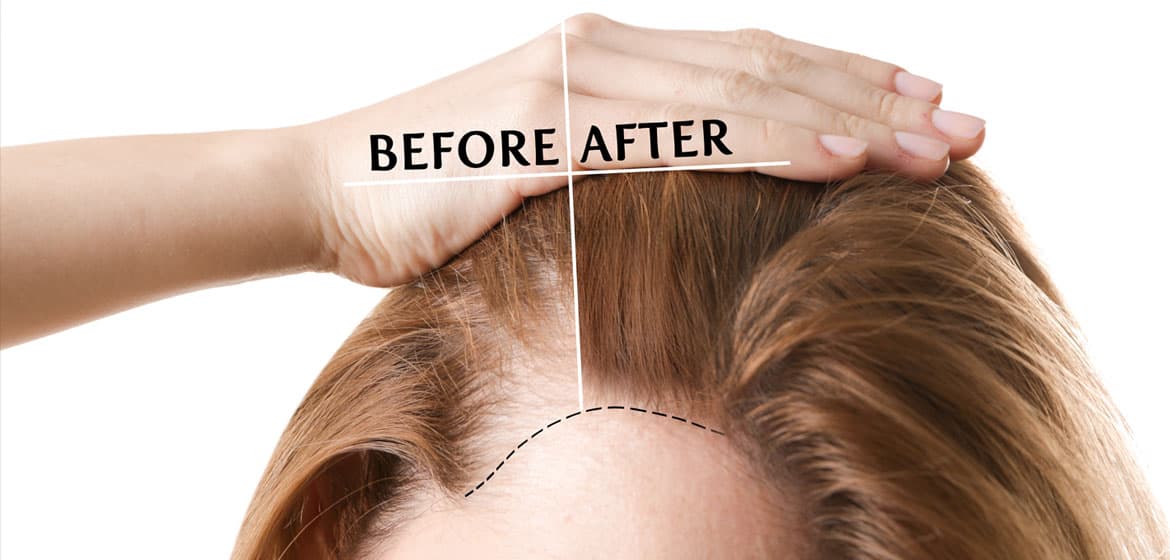 Hair Transplant Turkey Solutions at Sapphire Hair Clinic