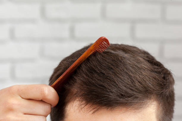 How Much Does Hair Transplant Cost in Istanbul Clinics?