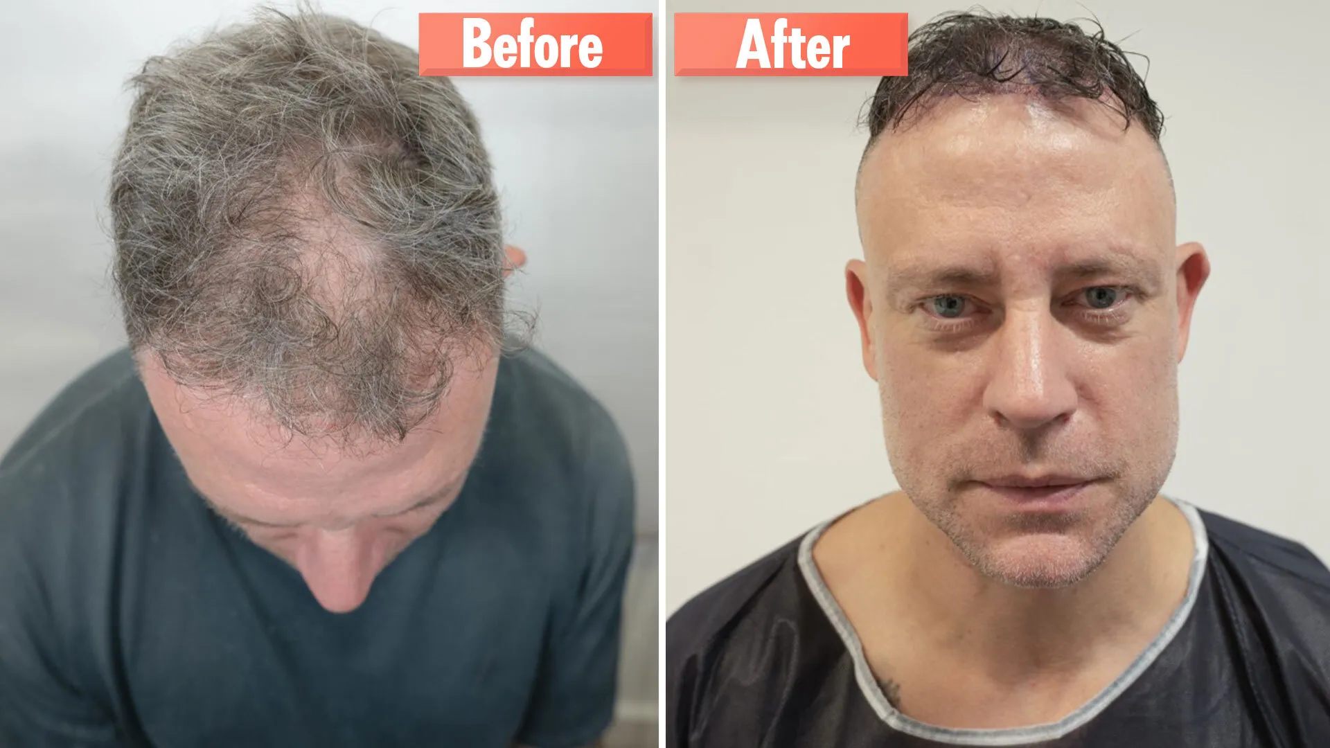 Hair Transplant London – Why Westminster Medical Group® Is the UK’s Top Choice