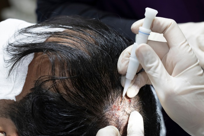 Hair Transplant Istanbul: Discover the Science Behind Success